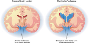 Figure (1): Medical illustration of the symptoms of Huntington's disease in the brain