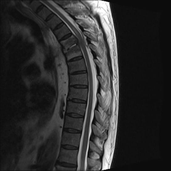 Spondylodiscitis - Neuropedia