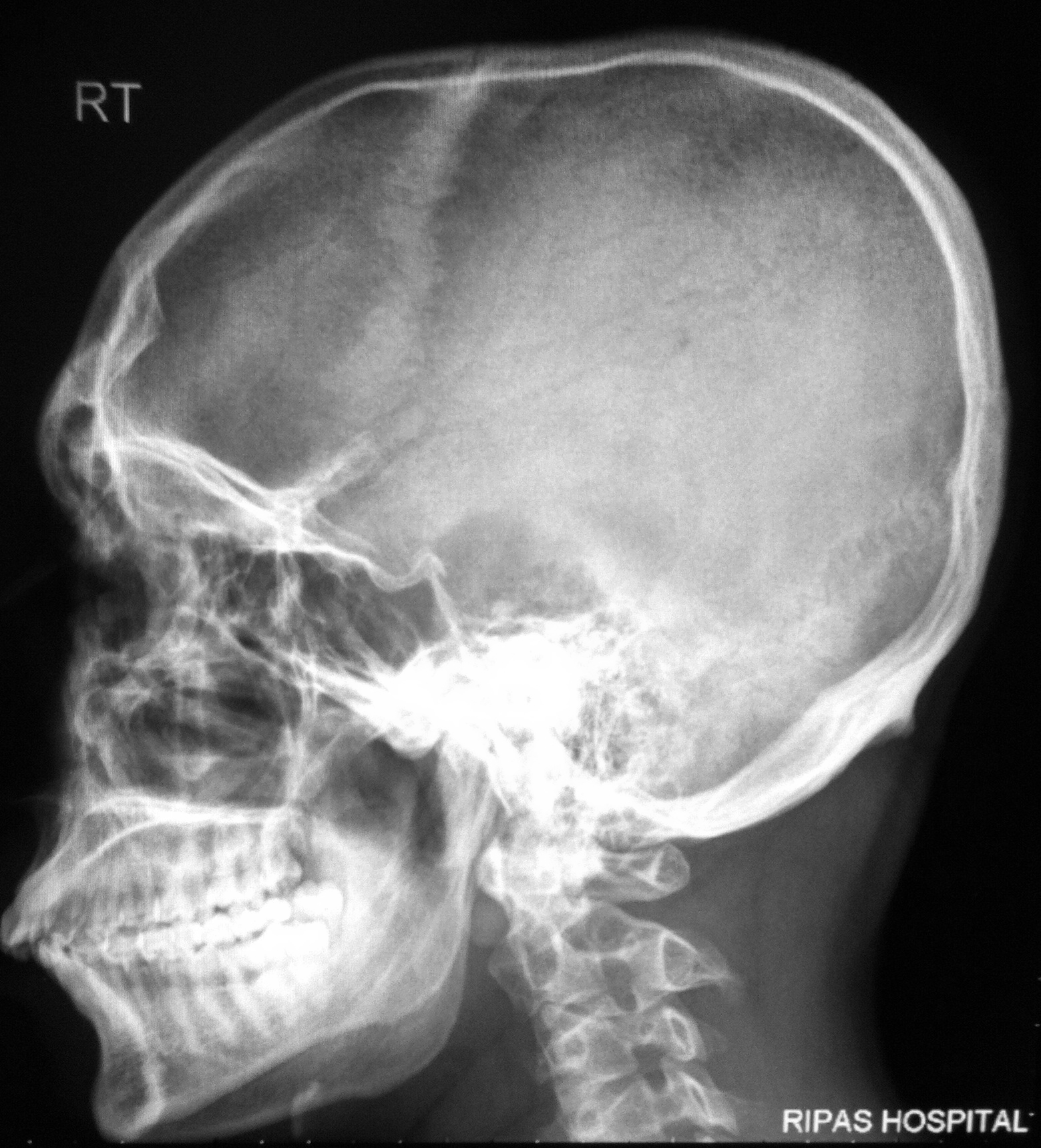 Basilar Skull Fracture Diagram