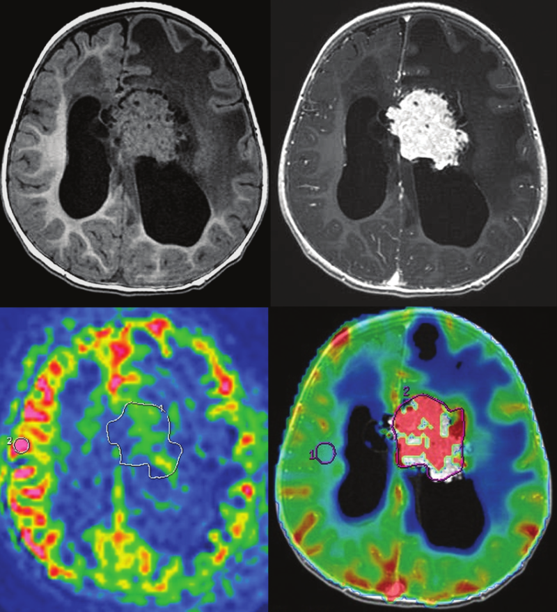 Choroid Plexus Tumors Neuropedia 