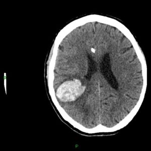 FIGURE (1): AXIAL NON-CONTRAST CT SCAN OF RIGHT FRONTOPARIETAL HEMORRHAGE WITH SURROUNDING EDEMA Case courtesy of Dr. Derek Smith rID: 34366.