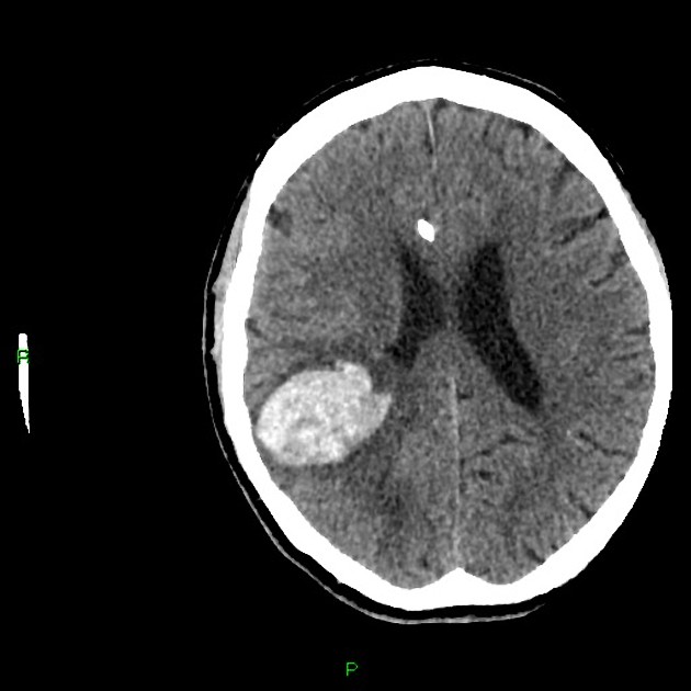 Secondary Stroke Prevention - Neuropedia