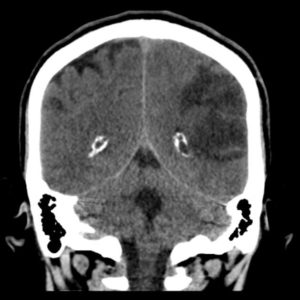 FIGURE (2): CT SCAN SHOWING TWO REGIONS OF ISCHEMIC STROKE IN THE TERRITORY OF THE LEFT MIDDLE CEREBRAL ARTERY. Case courtesy of Dr. David Cuete rID: 26882