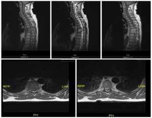 Figure 2. changing signal and avid enhancement of the T6 and T7 vertebral bodies and intervening discs. Epidural abscess, canal stenosis, and thoracic cord compression at T6/T7 level. L4/L5/S1 degenerative change.26