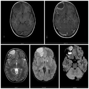 Figure 1. MRI shows the multiloculate morphology of the intracranial epidural collection located in the right supraorbital region. The collection is hypointense on T1-weighted and hyperintense on T2-weighted images, with a surrounding membrane that enhances with contrast administration.25