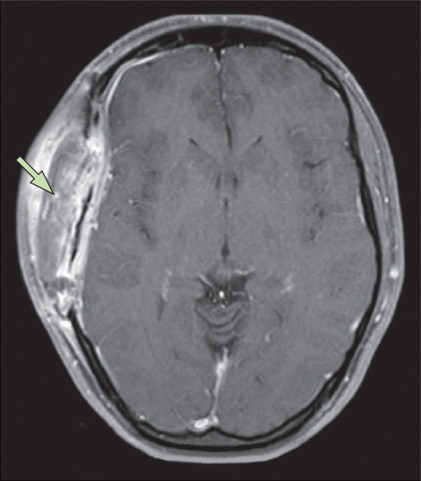 Epidural Abscesses - Neuropedia