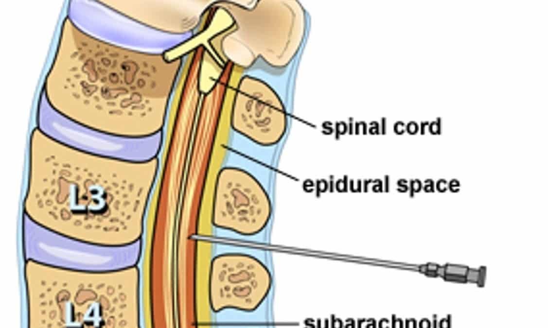 Lumbar Puncture
