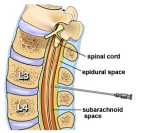 Figure 1. A needle is placed in the subarachnoid space at the level of the 3rd and 4th lumbar vertebra to collect a sample of cerebrospinal fluid.6