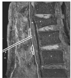Figure 2: Cadaveric sagittal section through lumbar spine showing proper needle trajectory 3 (from Boon et al.9)