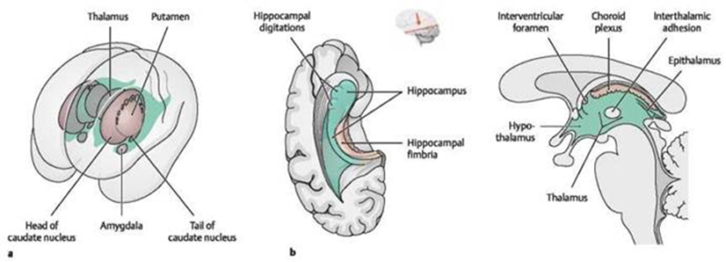 Intraventricular Central Neurocytoma - Neuropedia