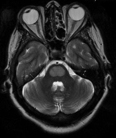 Case courtesy of The Radswiki, Radiopaedia.org. From the case rID: 11286