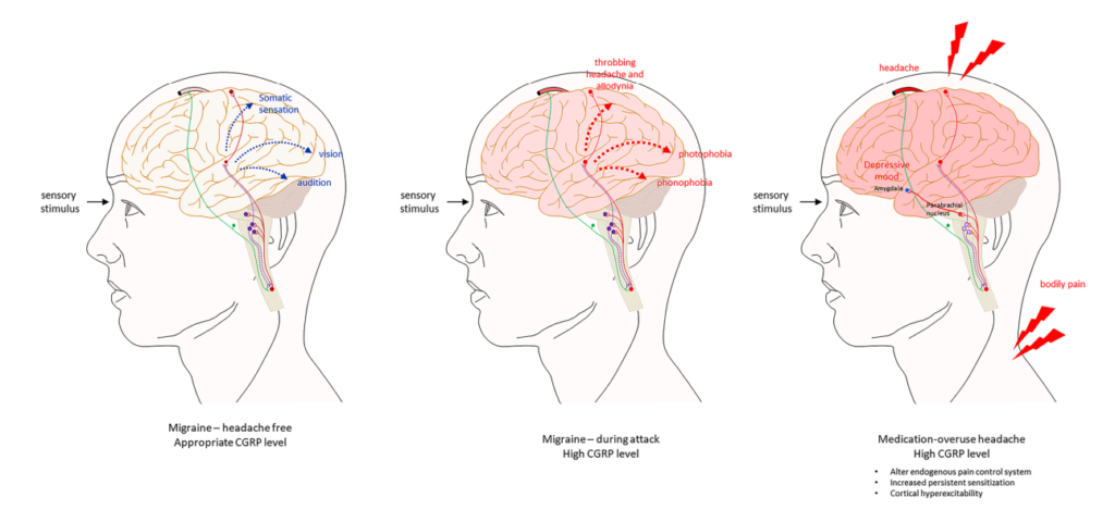 Medication Overuse Headache - Neuropedia