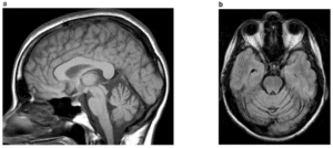 Figure 6: The MR (T1) brain (A) sagittal, (B) axial in a 54-year-old African-American male with genetically confirmed SCA2 who presented with cerebellar ataxia, dysarthria, slowed saccades, and peripheral neuropathy demonstrates cerebellar and brainstem atrophy. [17]