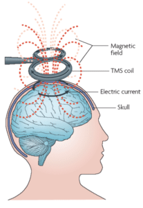 Figure 1: Transcranial magnetic stimulation 12