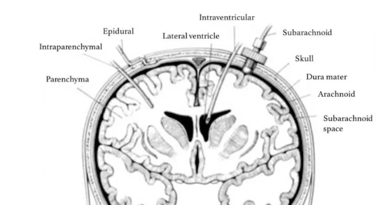 IR Signal of the Peripheral Neve Impregnated Ballistics Gel Immediately