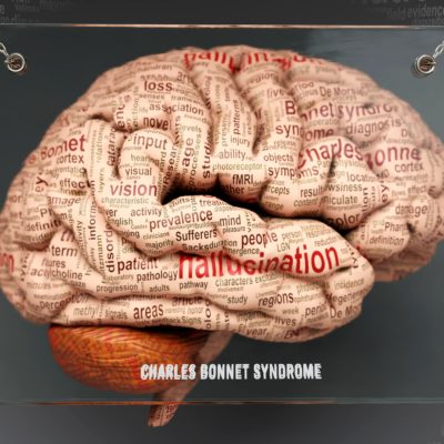 Charles Bonnet syndrome is a visual hallucination caused by the brain adapting to significant vision loss.