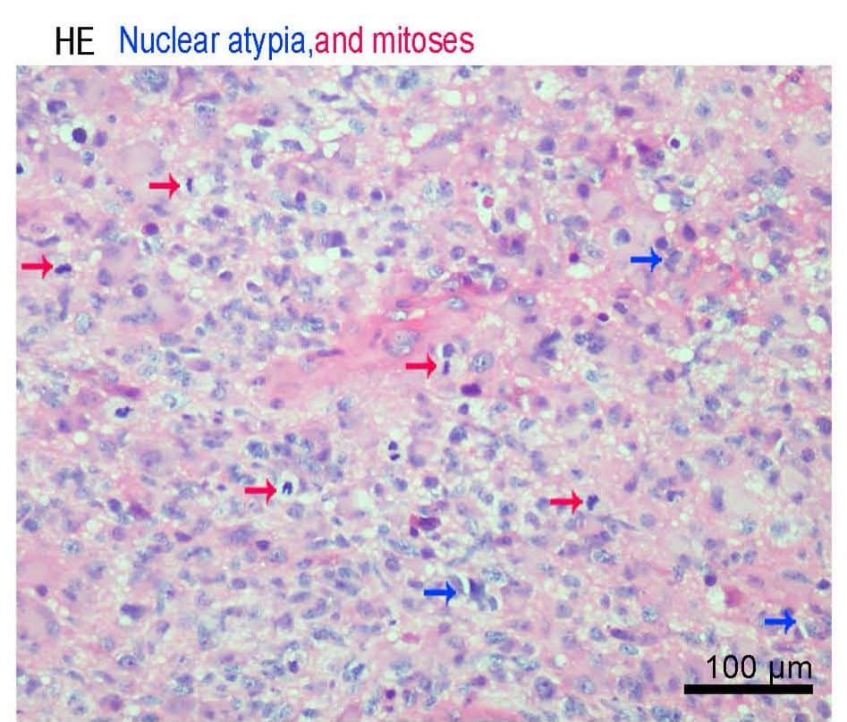 Figure 3: Nuclear Atypia and Mitosis 17