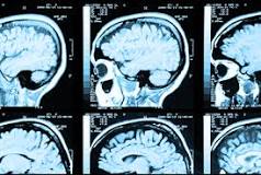 Figure 4: Deep Brain Stimulation: A New Option for Tourette Syndrome.32