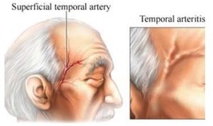 Figure (1): Thickening and scalp tenderness on presentation due to temporal artery vasculitis12.