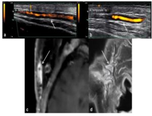                 High-resolution MRI has been demonstrated to be useful for diagnosing and monitoring GCA over time6. On high-resolution post-contrast images, vasculitis appears as increased vessel wall thickness and edema with increased mural enhancement6. The most current EULAR guidelines advocated using high-resolution 3-T MRI of cranial arteries for GCA diagnosis if US is unavailable or inconclusive6.