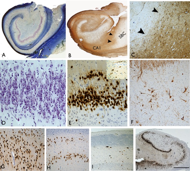 Typical-pathology-features-of-hippocampal-sclerosis-in-epilepsy-A-Luxol-fast.jpg