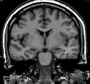 bilateral-mesial-temporal-sclerosis