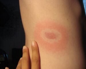 Erythema Marginatum in a patient diagnosed with Lyme disease