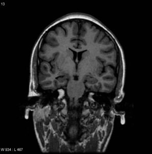 MTS in right side(coronal T2) 69