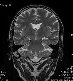 MTS in left side(coronal T2) 69