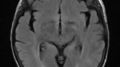 Increased T2/FLAIR signal in both parietal and occipital lobes in a relatively symmetrical fashion showing vasogenic edema in a patient diagnosed with PRES.