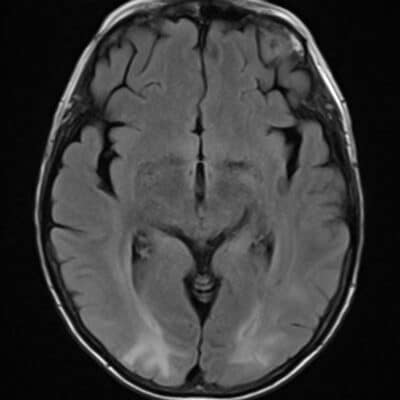 Increased T2/FLAIR signal in both parietal and occipital lobes in a relatively symmetrical fashion showing vasogenic edema in a patient diagnosed with PRES.