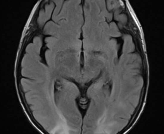 Increased T2/FLAIR signal in both parietal and occipital lobes in a relatively symmetrical fashion showing vasogenic edema in a patient diagnosed with PRES.