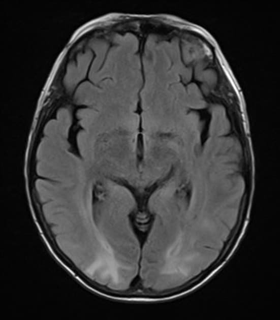 Increased T2/FLAIR signal in both parietal and occipital lobes in a relatively symmetrical fashion showing vasogenic edema in a patient diagnosed with PRES.