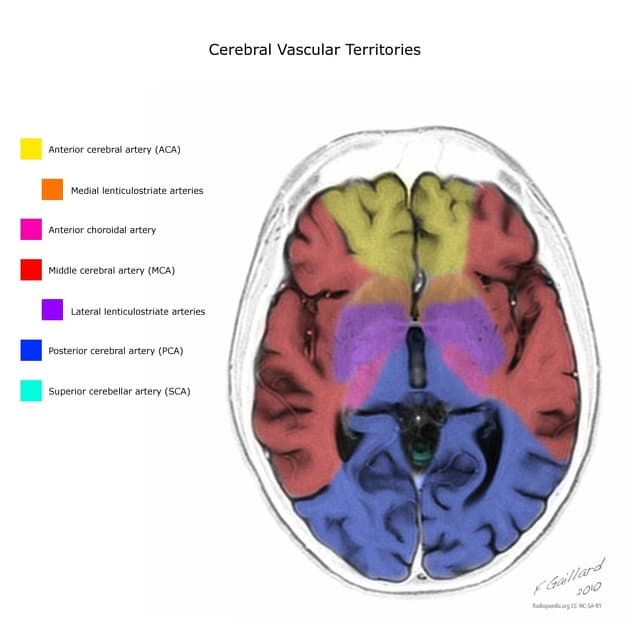 Cerebral vascular territories for a better understanding of the affected blood supply in the case of lateral pontine stroke [14].