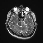 Pons with a left-sided infarct