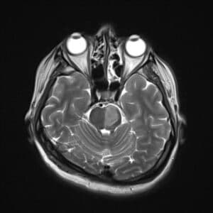 CT scan of the brain showing infarction on the left side of the pons in a case diagnosed with lateral pontine stroke [15].