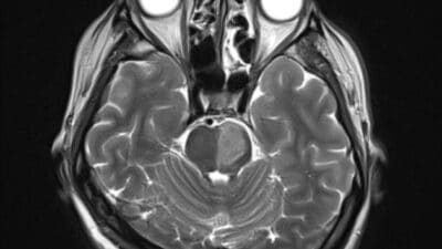 Pons with a left-sided infarct