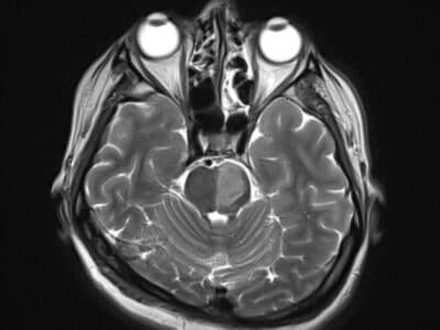 Pons with a left-sided infarct