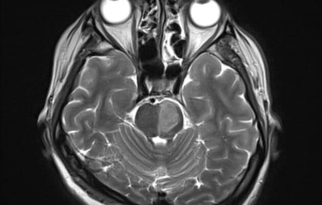 Pons with a left-sided infarct