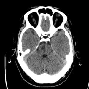 CT scan of the brain showing infarction on the right side of the pons in a case diagnosed with lateral pontine stroke [16].