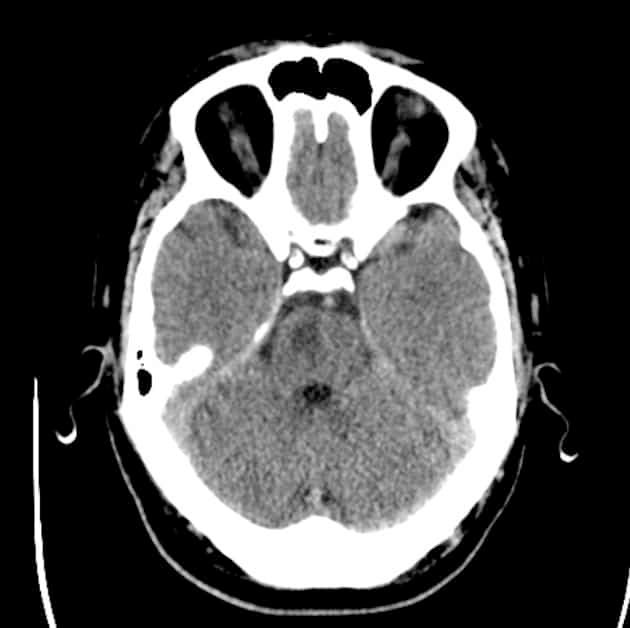 Lateral Pontine Stroke - Neuropedia