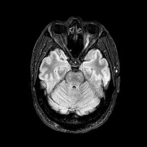 Figure 2: Left Optic Neuritis on T2/Flair MRI with effacement of the CSF within the optic nerve sheath [24].