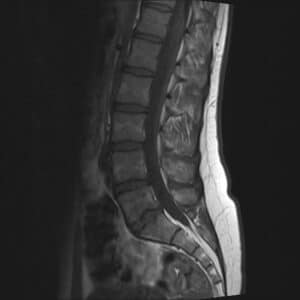 Figure 1: Obvious enhancement of anterior nerve roots of cauda equina, a typical finding in cases diagnosed with Miller Fisher Syndrome [7].