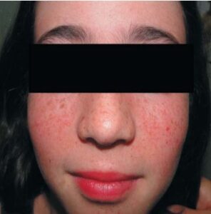 FIGURE 4: Facial angiofibroma at early stage