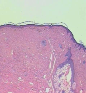 FIGURE 6: Histopathological examination of facial angiofibroma: HE. 25X