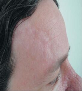 FIGURE 8: Fibrous forehead plaque