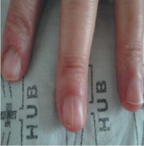 FIGURE 10: Longitudinal canalicular nail depression, corresponding to  ungual fibroma in the nail matrix 