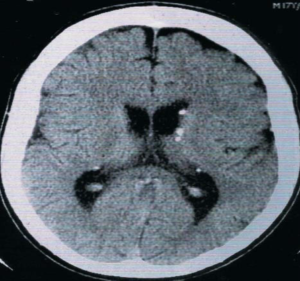 FIGURE 11: Cranial computed tomography scan: calcification in the ventricular walls