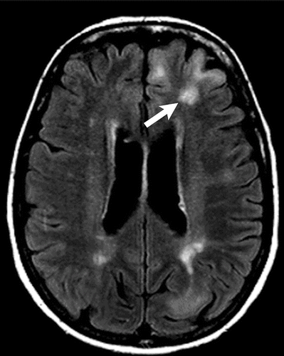 Figure 12. Axial FLAIR MR image shows multiple hyperintense lesions (arrow) in the cortex, consistent with cortical tubers in tuberous sclerosis.57