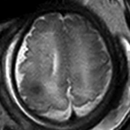 Figure 13: single-shot T2-weighted EPI shows cortical tuber.58